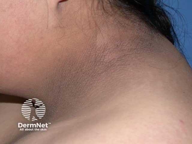 acanthosis nigricans neck