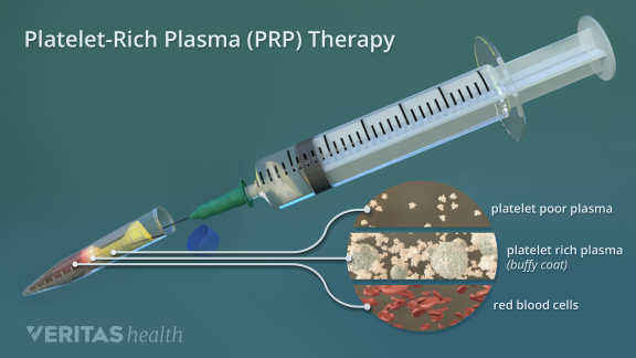 illustration of prp injection for hair growth