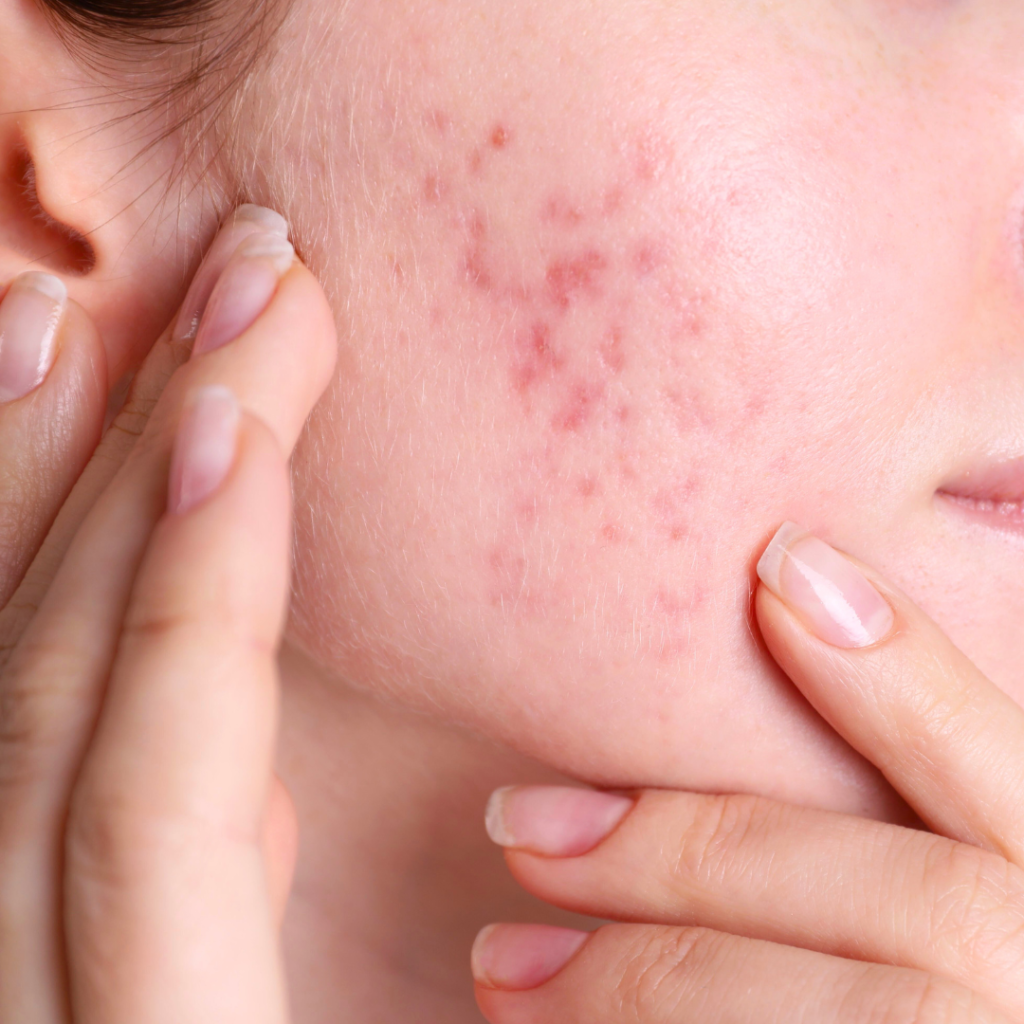 acne skin rash from stress