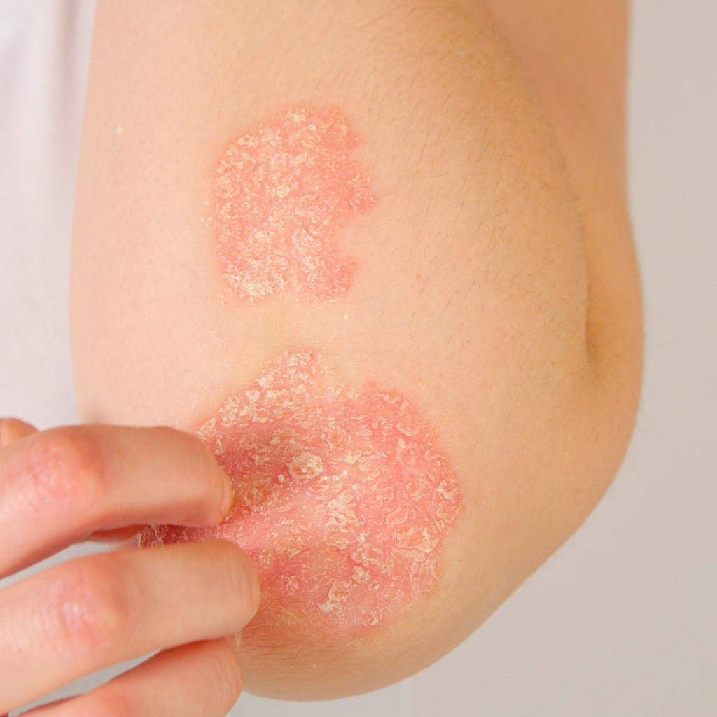 psoriasis skin rash from stress