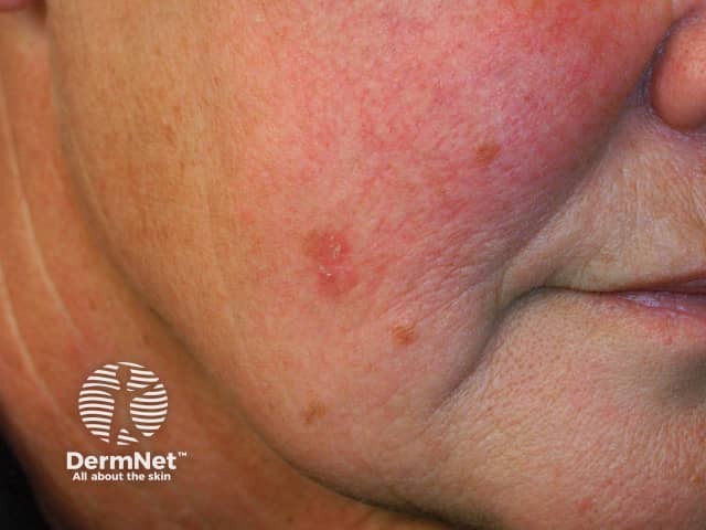 precancerous skin lesion on the cheek