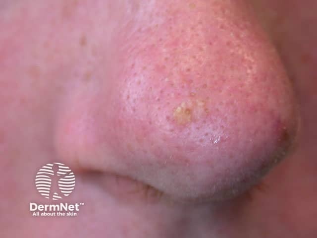 precancerous lesion actinic keratosis on the nose