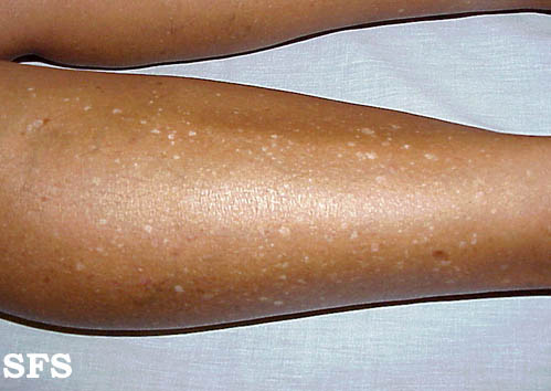 white spots on legs from idiopathic guttate hypomelanosis