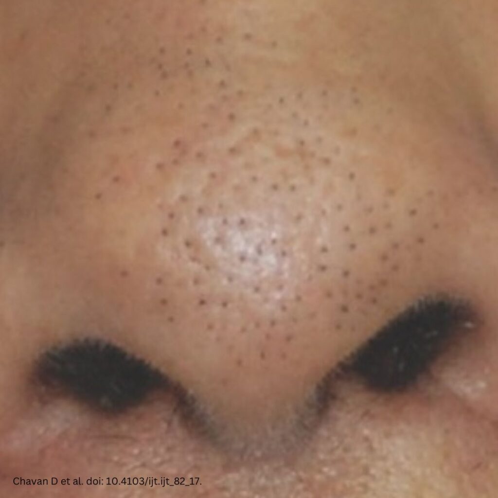 black spots on the nose from trichostasis spinulosa